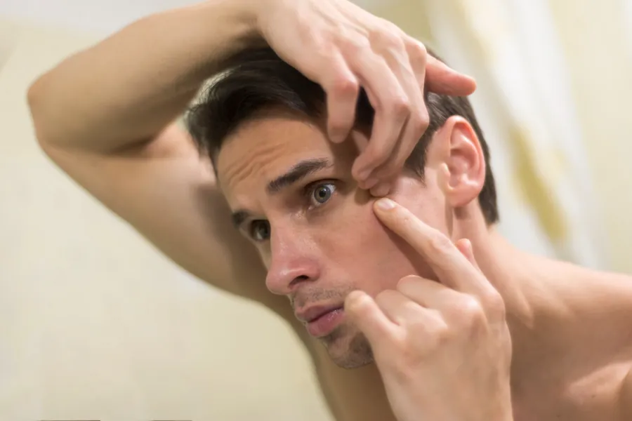 Young man in front of the mirror squeezing a pimple on his forehead