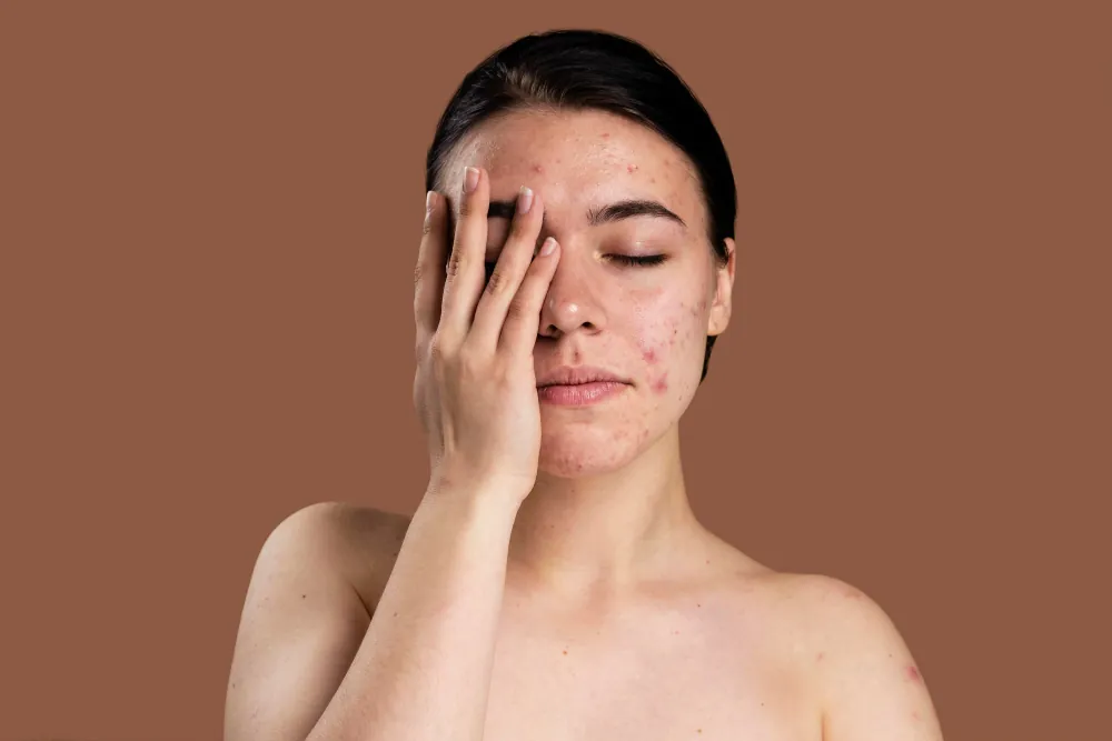 Young woman with acne-affected skin holding a hand to her face against a neutral background