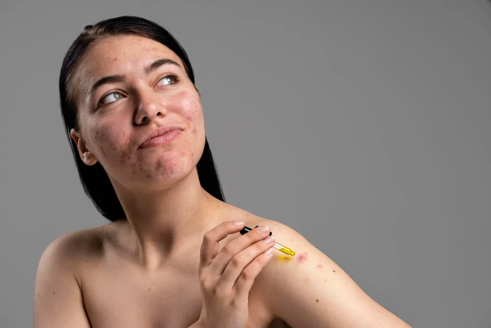 Young woman with acne-prone skin using a dropper to apply serum to the pimples on her shoulder, against a grey background