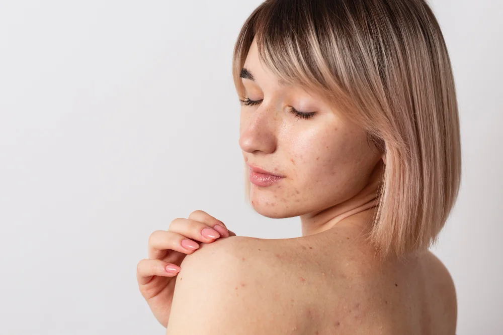Young woman in profile with small pimples on her face and shoulder, touching her shoulder with her fingers